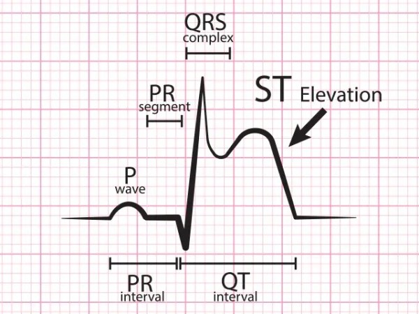 ST Elevation Myocardial&nbsp;Infarction